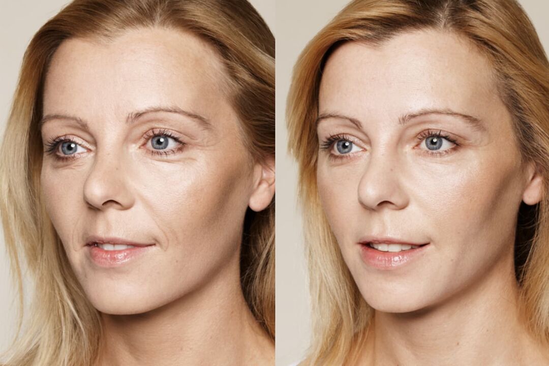 Use experience before and after using Valeria's intenskin cream